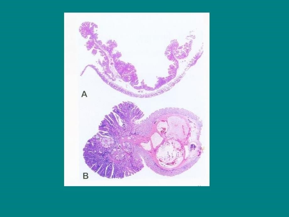 大肠癌筛查培训课件-病理部分ppt课件_第5页