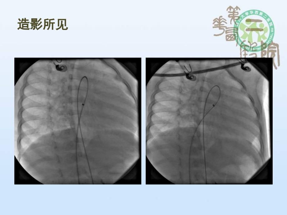 冠状动脉瘘介入治疗_华益民课件_第4页