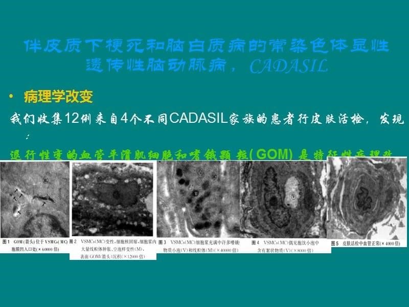 单基因遗传性脑血管病 湘雅医院ppt课件_第5页