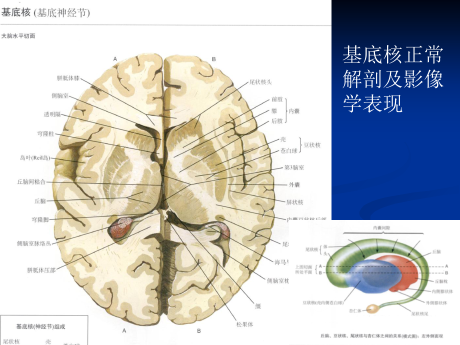 大脑深部对称性灰质核团病变的病因与mri诊断复习课程_第3页