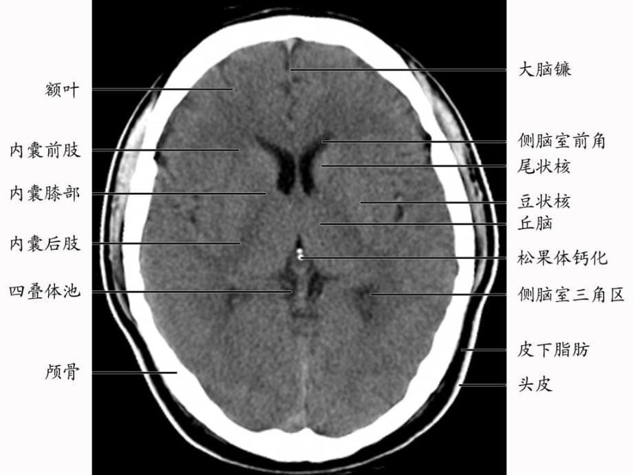大脑深部对称性灰质核团病变的病因与mri诊断复习课程_第5页