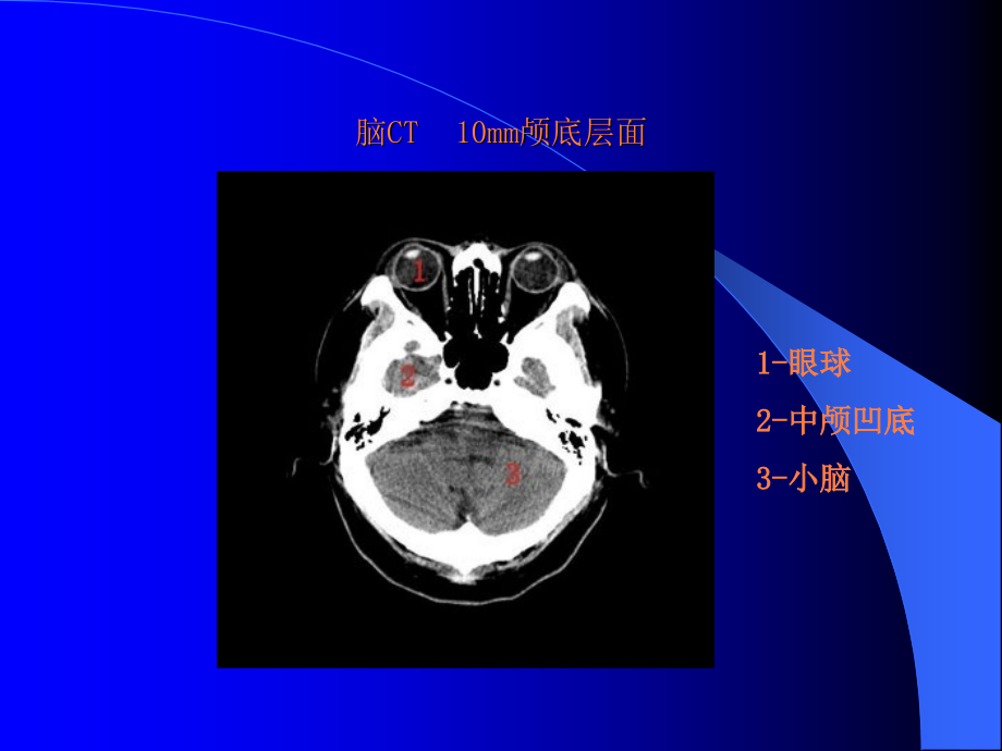 如何分析脑ct(同济大学)ppt课件_第4页