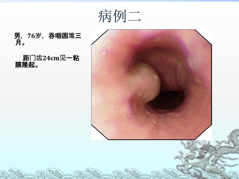 消化道隆起性病变的超声内镜诊断ppt课件_第3页