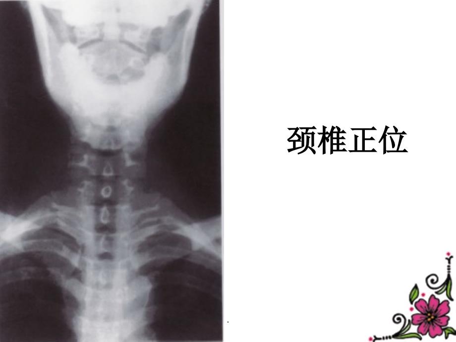 颈椎X线ppt课件_第2页