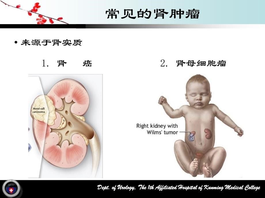 《肾肿瘤》-精选课件（公开PPT）_第5页