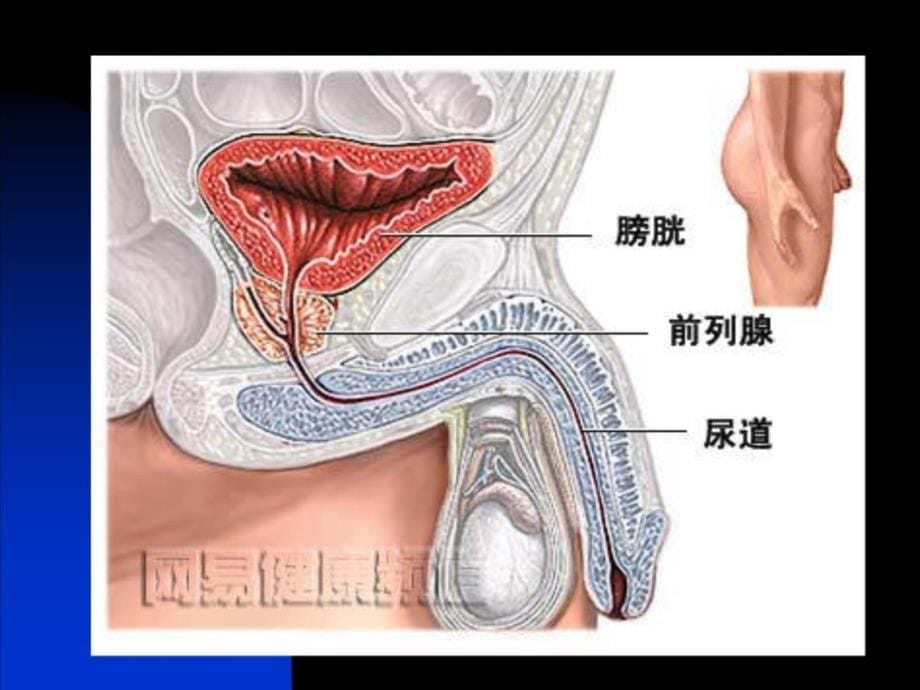 前列腺炎PROSTATITIS教学内容_第5页