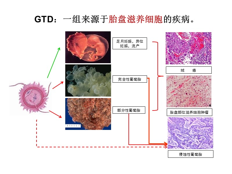 妊娠滋养细胞疾病GestationalTrophoblasticDiseaseGTD教学文案_第2页