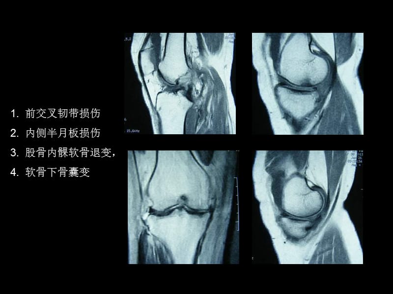 内侧半月板移植二次镜检1例报道上课讲义_第3页