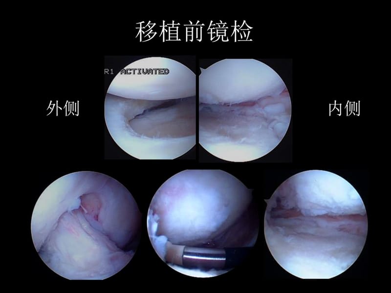 内侧半月板移植二次镜检1例报道上课讲义_第5页