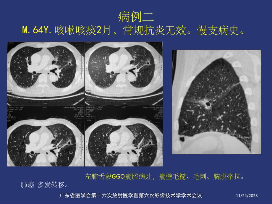 薄壁囊腔型肺癌的影像诊断和鉴别诊断_第3页