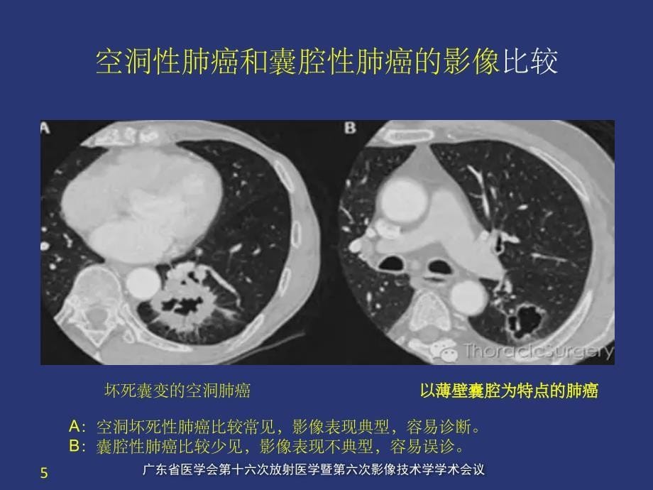 薄壁囊腔型肺癌的影像诊断和鉴别诊断_第5页