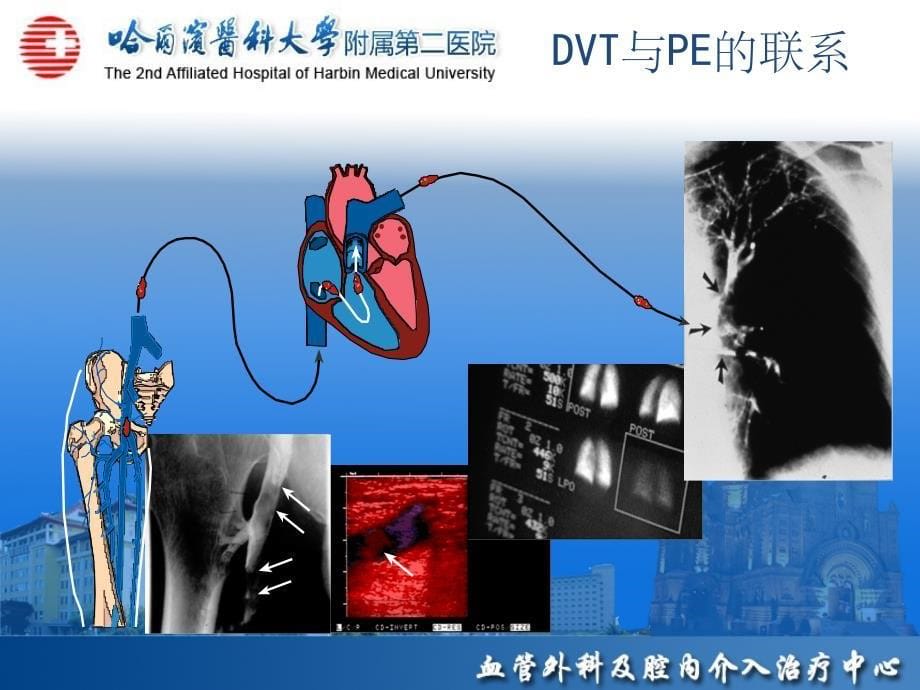 静脉血栓栓塞(VTE)诊断、治疗和预防ppt课件_第5页