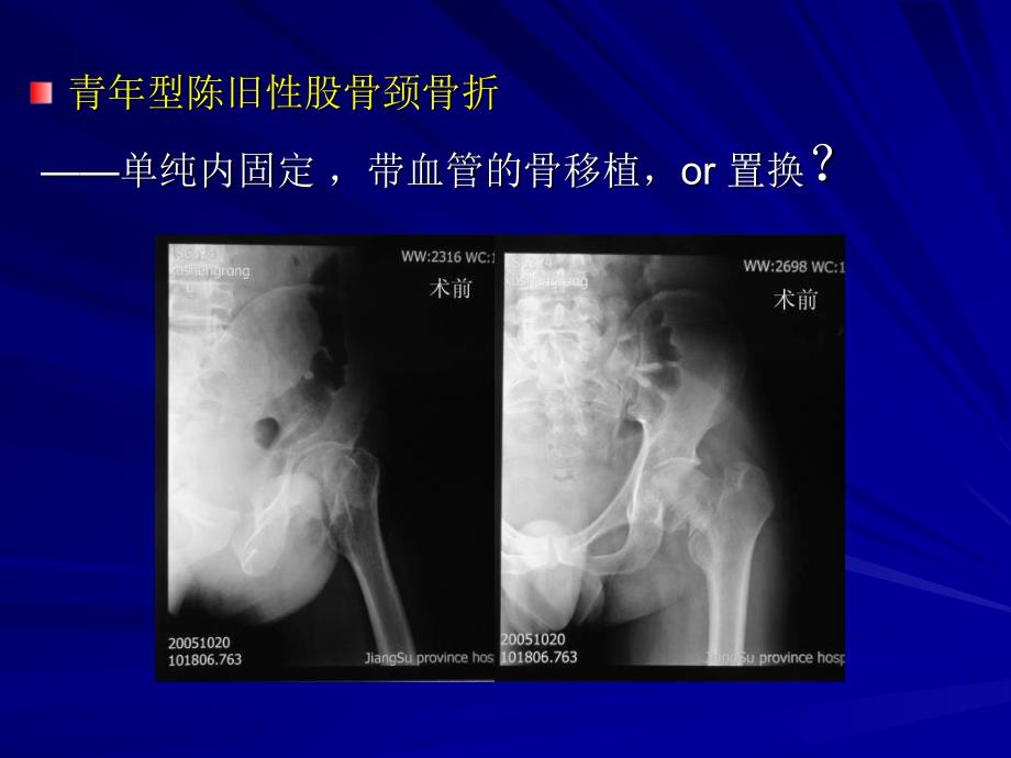 吻合血管游离腓骨移植术治疗股骨颈陈旧骨折及骨不连教学内容_第2页