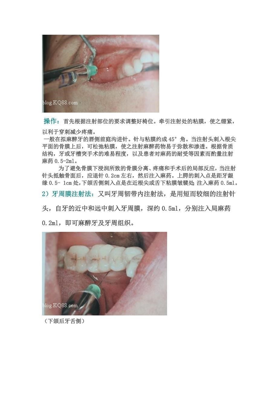 规范化操作之口腔常用几种麻醉图.doc_第5页