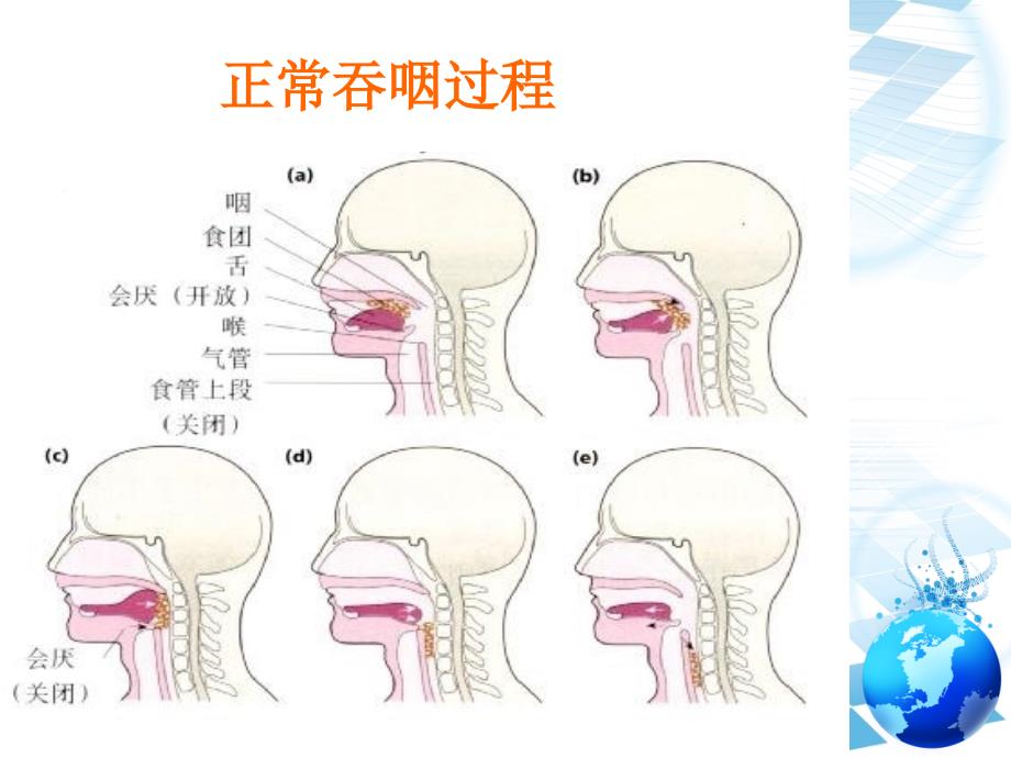 老年人住院期间误吸的预防与处理PPT课件_第3页