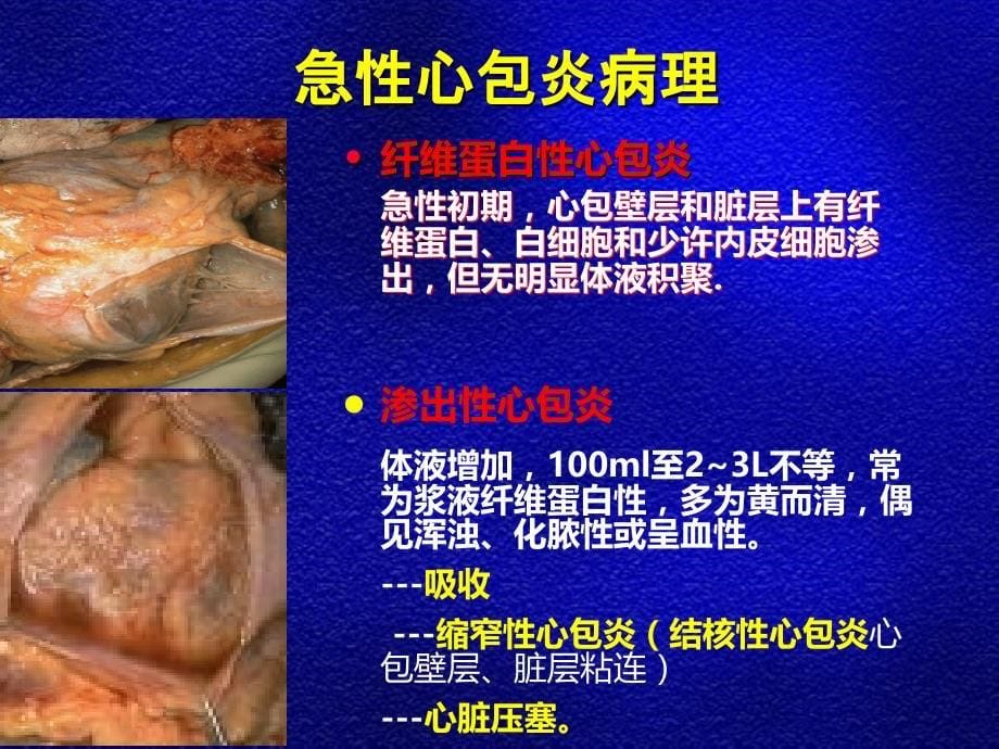 第十节 急性心包炎PPT课件_第5页