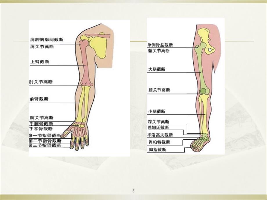 截肢术后VSD护理查房PPT课件_第3页