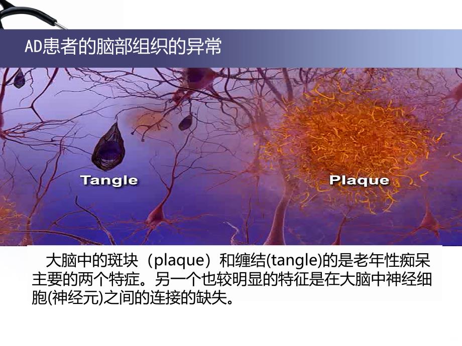 阿尔海默茨氏综合症(老年性痴呆)PPT课件_第4页