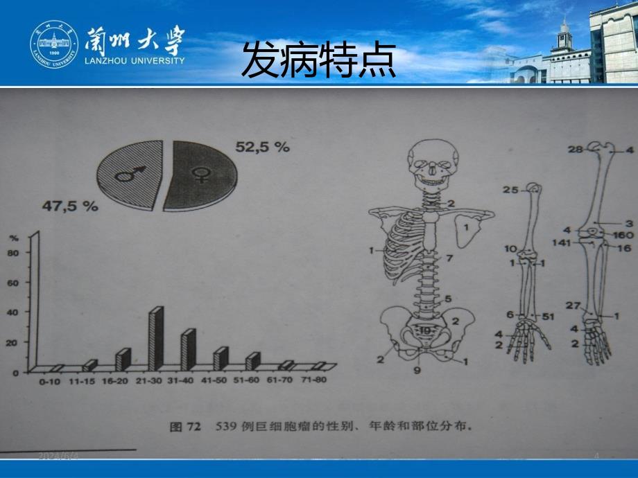 骨巨细胞瘤兰大PPT课件_第4页