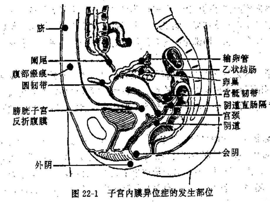 子宫内膜异位症和子宫腺肌病PPT课件_第5页