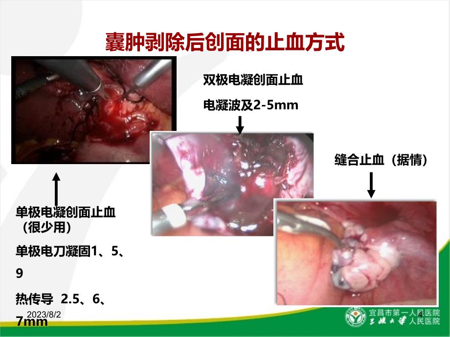 妇科腹腔镜现状思考与展望PPT课件_第4页