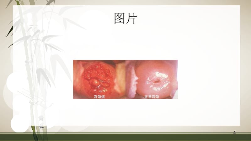 宫颈癌解剖及相关知识PPT课件_第4页