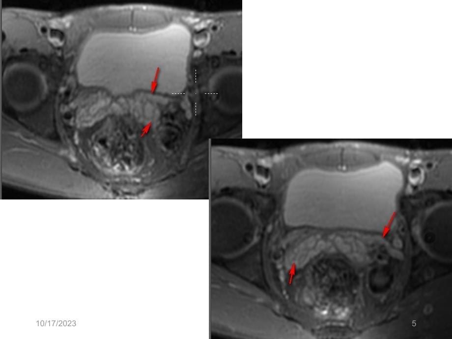 膀胱癌的CT诊断PPT课件_第5页