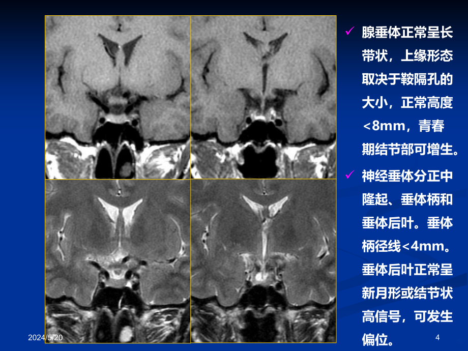 鞍区病变影像诊断-(上)PPT课件_第4页