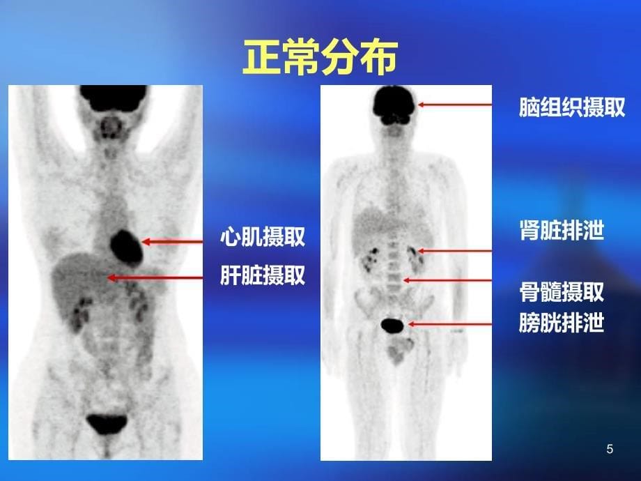 FDG-PET非肿瘤摄取PPT课件_第5页