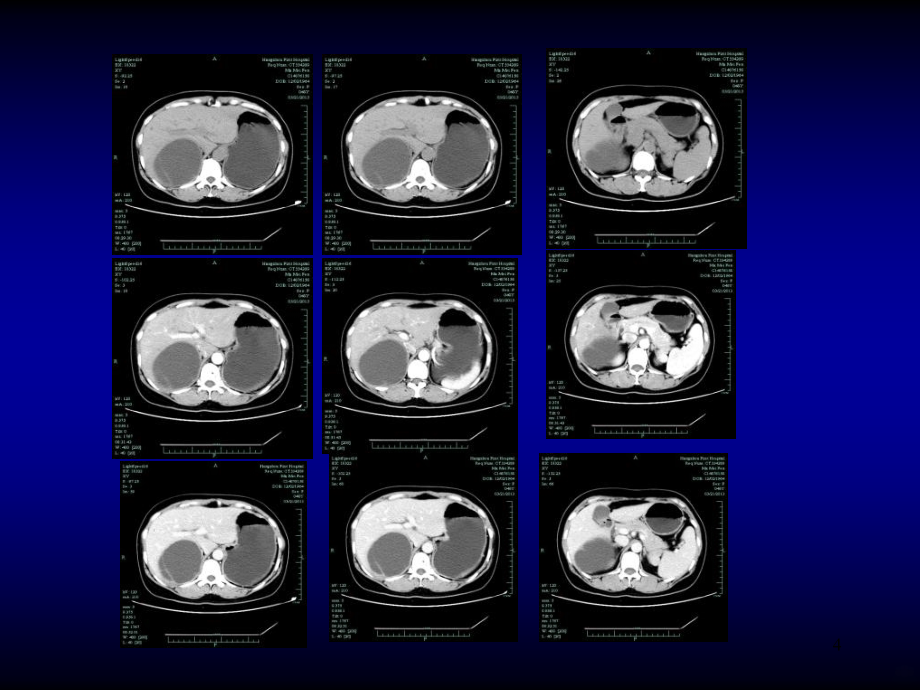 肝胆疑难读片讲义PPT课件_第4页