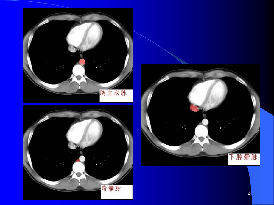 腹部CT读片PPT课件_第4页