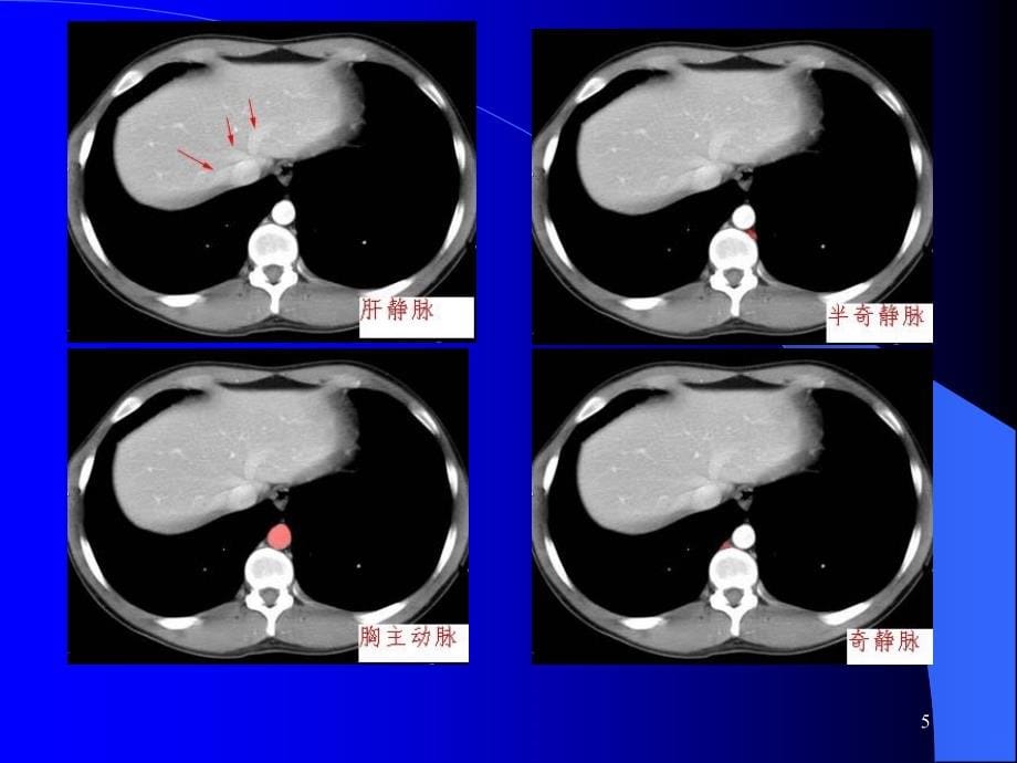 腹部CT读片PPT课件_第5页