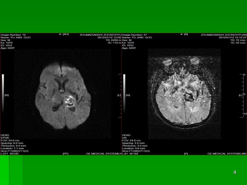 海绵状血管瘤及脑血肿MRI表现PPT课件_第4页