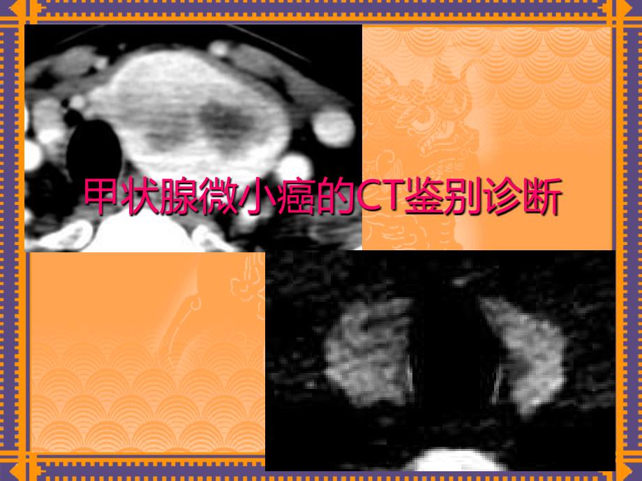 甲状腺病变的CT诊断PPT课件_第1页