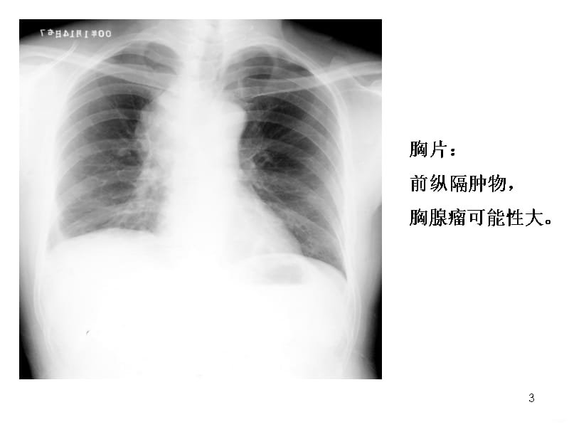 北京协和医院肺癌的肺外表现PPT课件_第3页