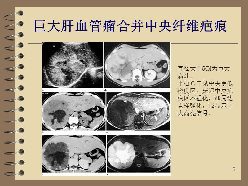 不典型肝脏血管瘤影像诊断PPT课件_第5页