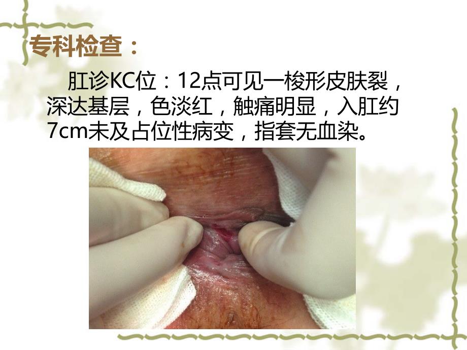 肛裂护理查房[31页]_第4页