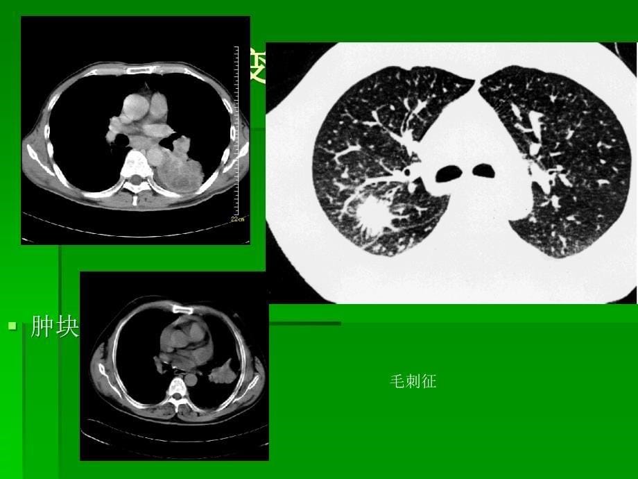 胸部异常CT表现ppt课件_第5页
