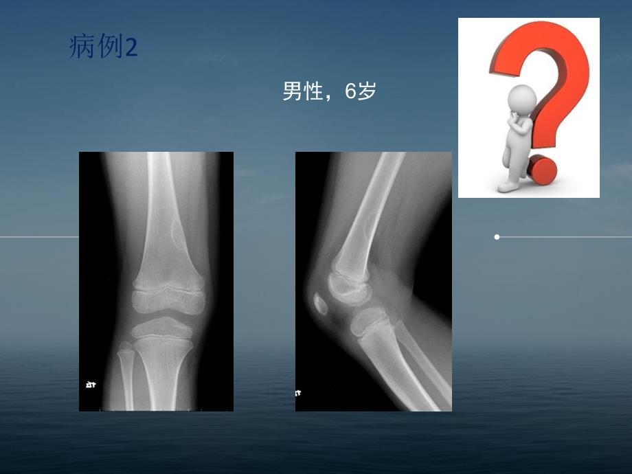 非骨化性纤维瘤的x线诊断及鉴别诊断培训资料_第2页