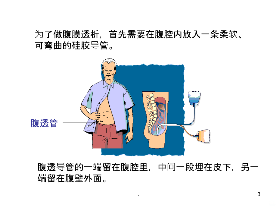 腹膜透析治疗护理讲义PPT课件_第3页