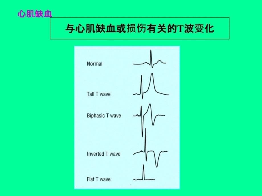 心电图(心肌缺血和心肌梗死)ppt课件_第5页