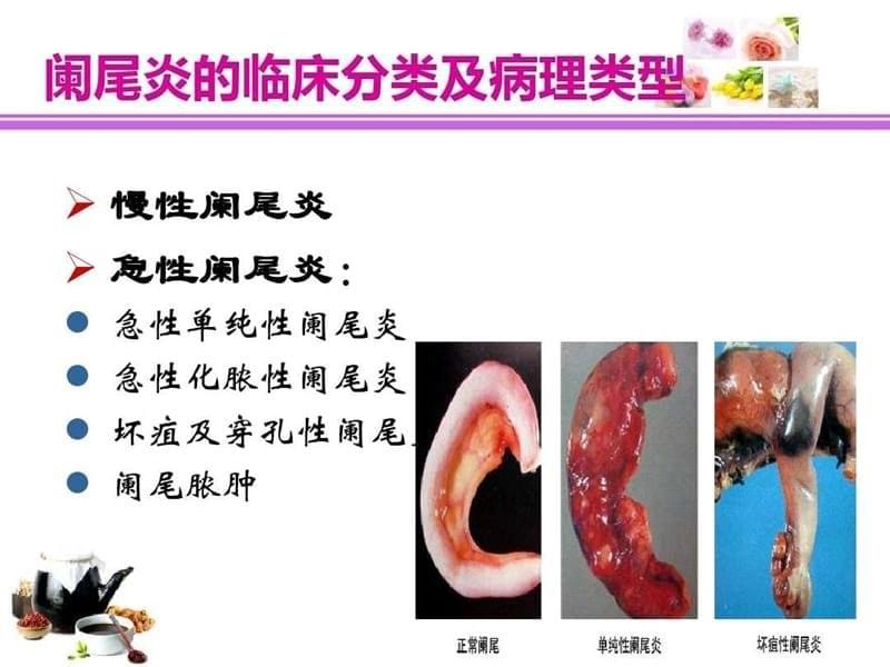 阑尾炎的术前术后护理PPT课件_第5页