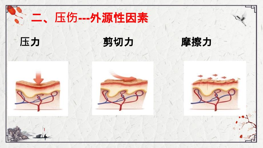 压伤的护理PPT课件_第4页