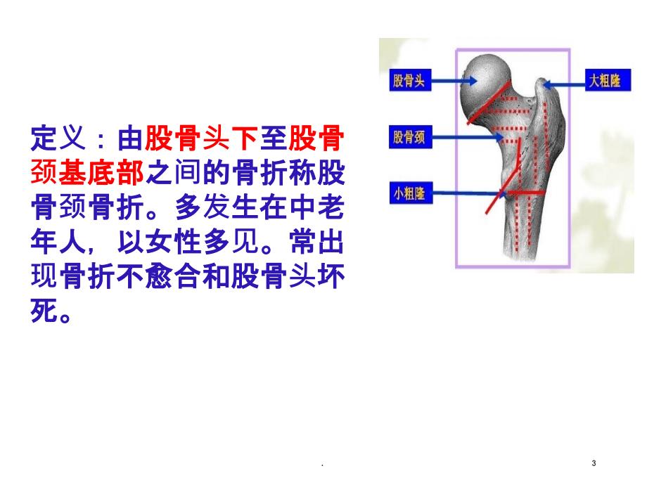 新版股骨颈骨折的护理培训PPT课件_第3页