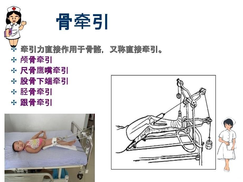 牵引术并发症的护理及预防PPT课件_第5页