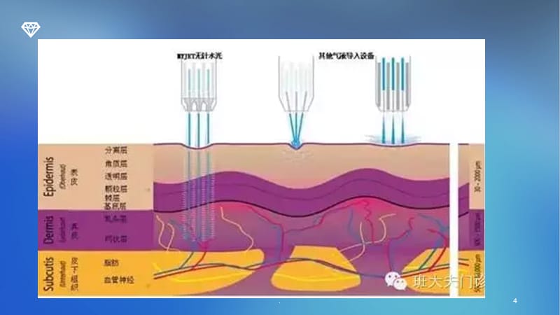 郭文丽：无针水光注射的基本知识PPT课件_第4页