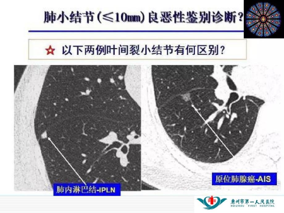 肺内淋巴结_第3页