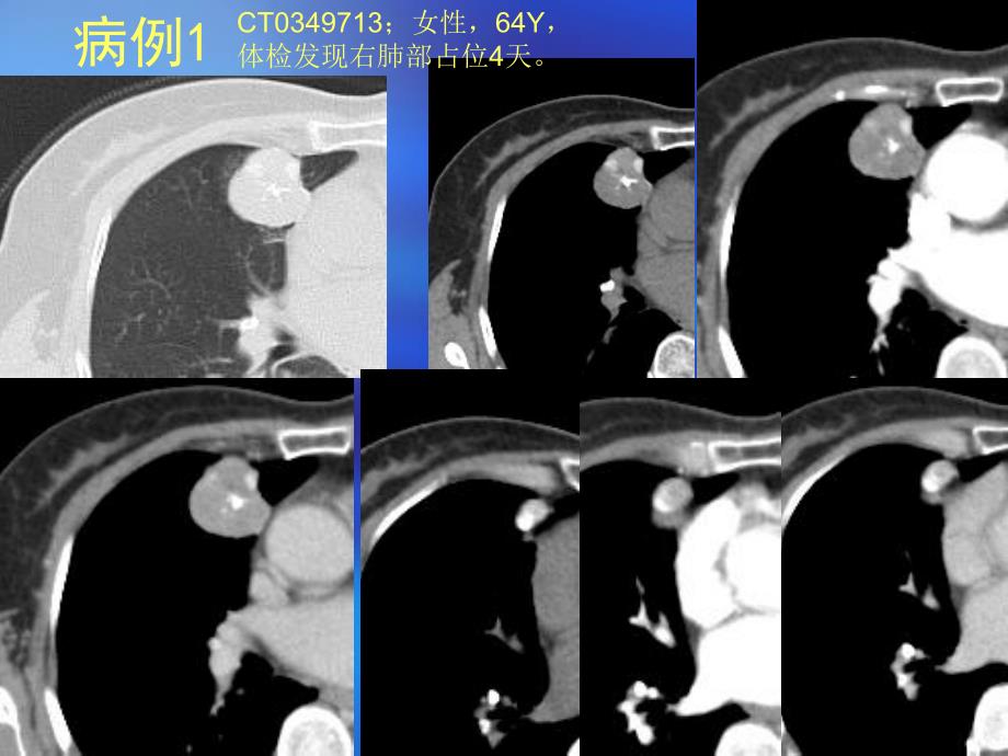 肺部错构瘤ct鉴别诊断病例随访知识课件_第1页