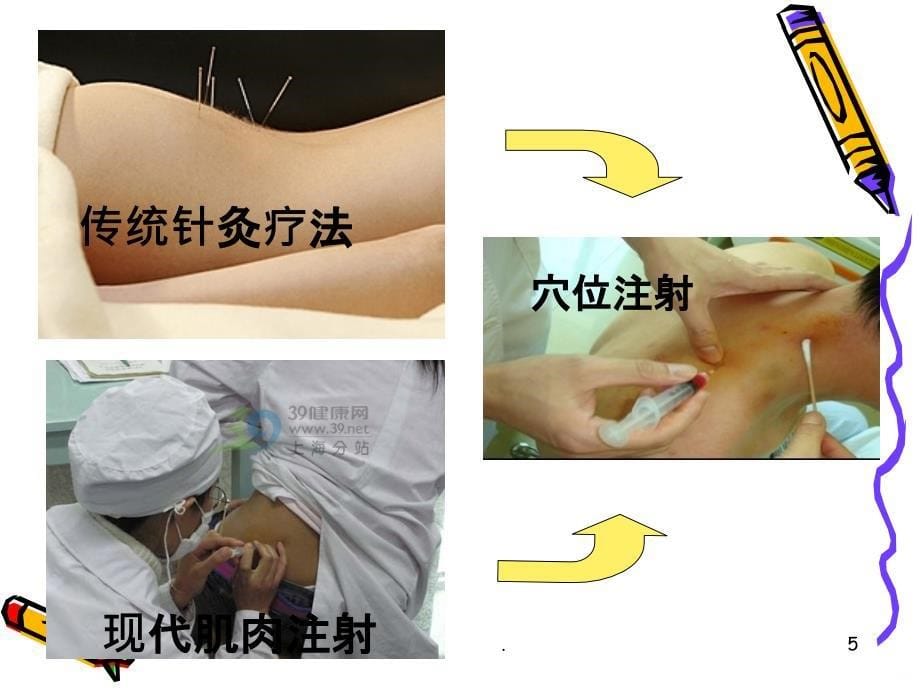 中医针灸护理穴位注射法PPT课件_第5页