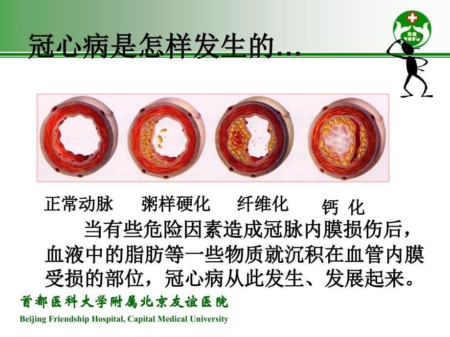 心绞痛与急性心肌梗死的识别培训讲学_第5页